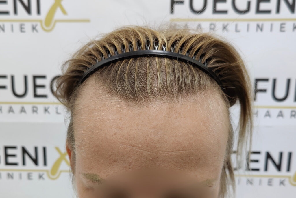 Female Hairline Lowering FUE