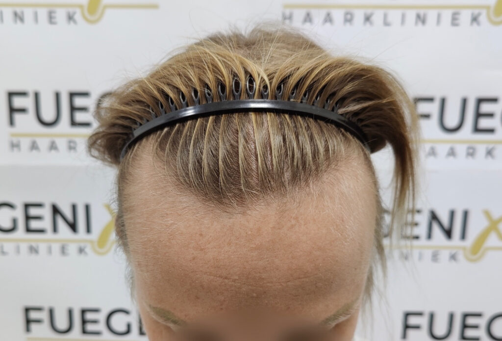 Female Hairline Lowering FUE