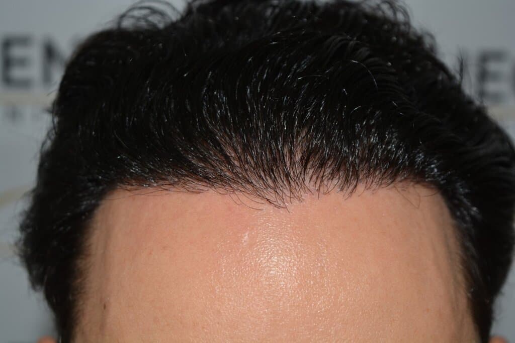 One Surgery Repair