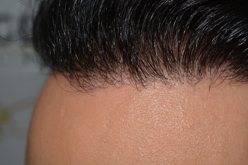One Surgery Repair