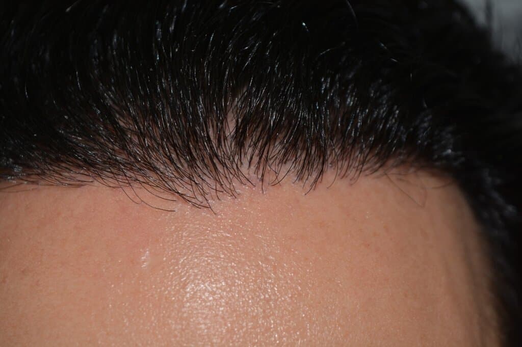One Surgery Repair