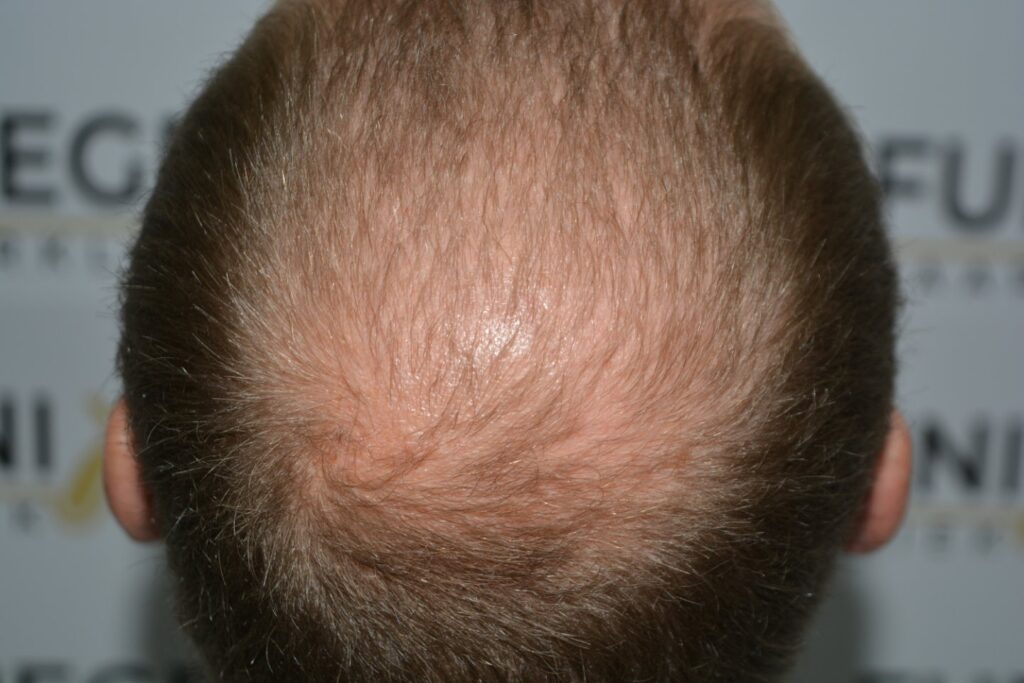 Next Level Crown Comb Through