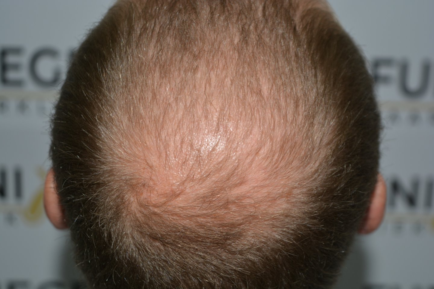 Before – Next Level Crown Comb Through