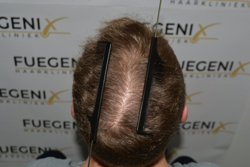 Next Level Crown Comb Through