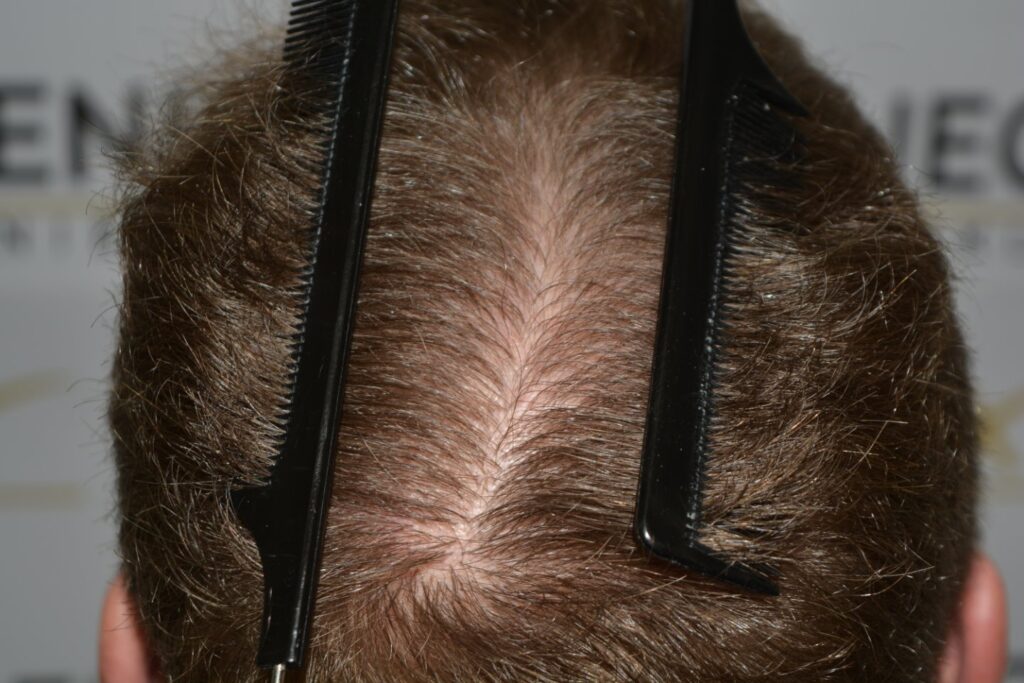 Next Level Crown Comb Through