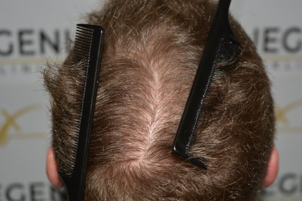 Next Level Crown Comb Through