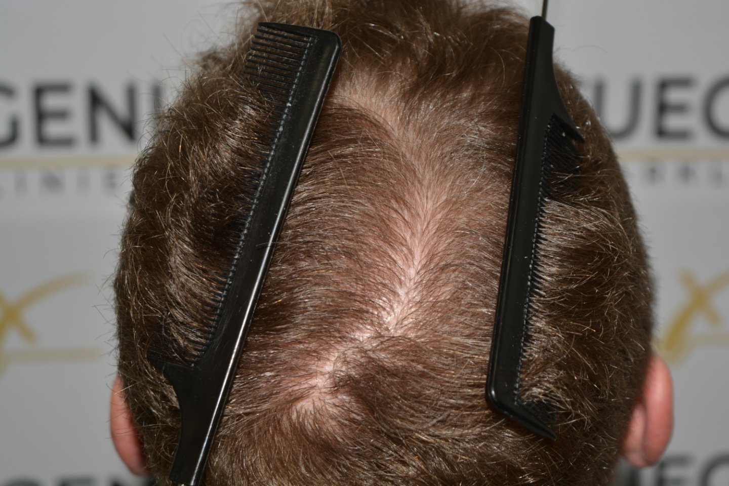 After – Next Level Crown Comb Through