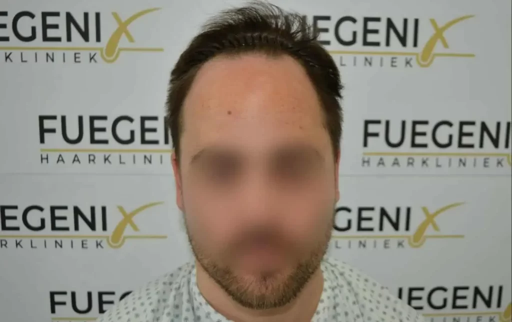The Hairline That You Dream Of