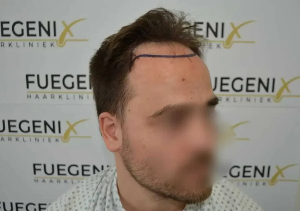 The Hairline That You Dream Of