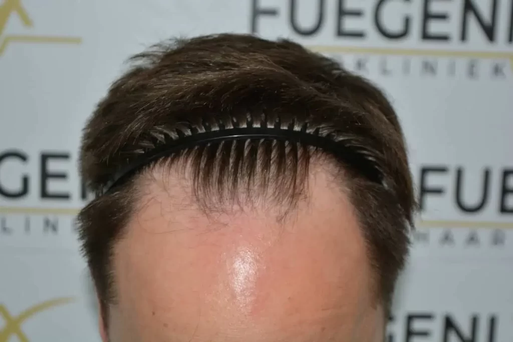 The Hairline That You Dream Of