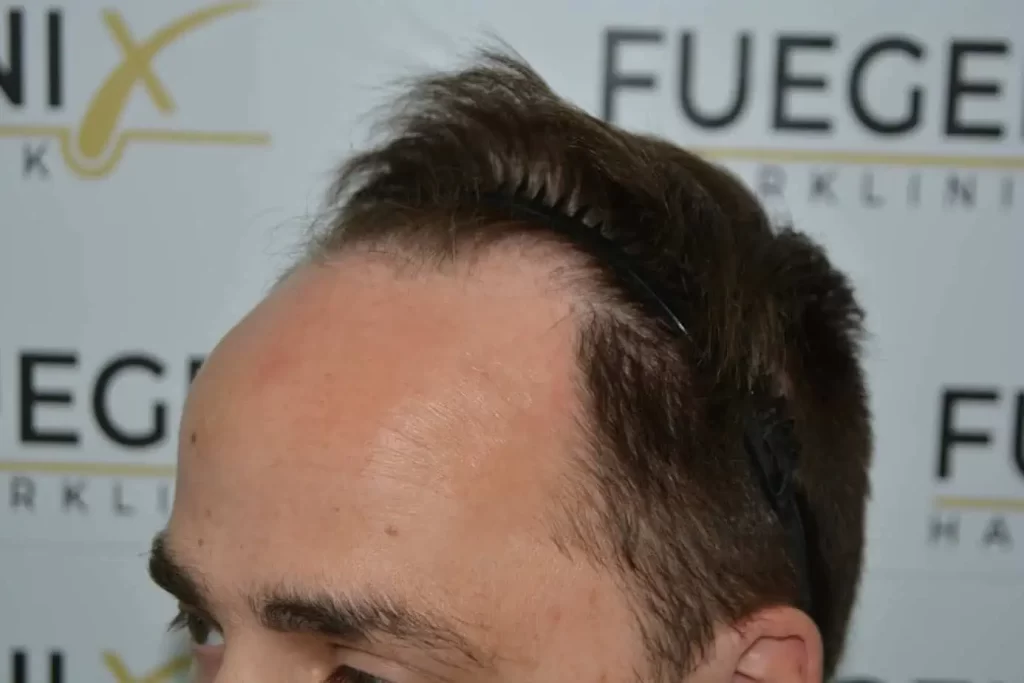 The Hairline That You Dream Of