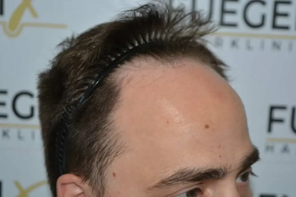 The Hairline That You Dream Of