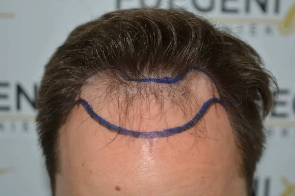 The Hairline That You Dream Of