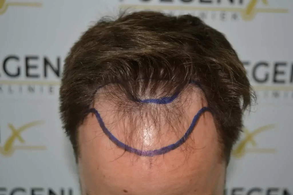 The Hairline That You Dream Of