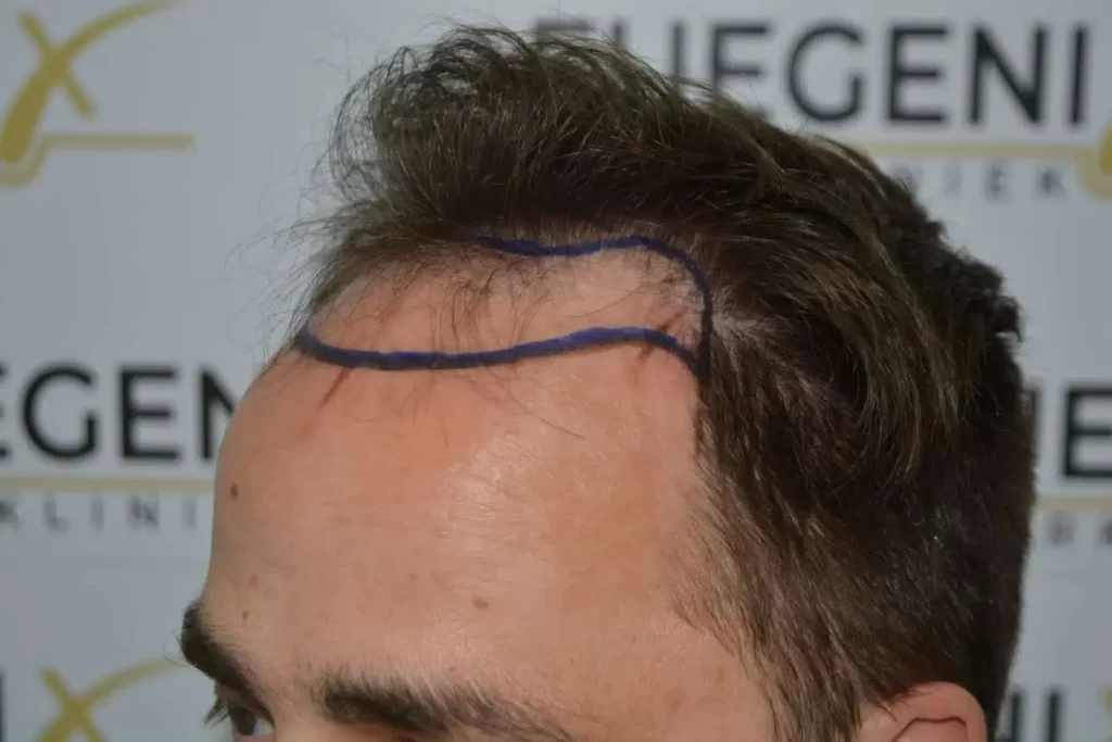 The Hairline That You Dream Of