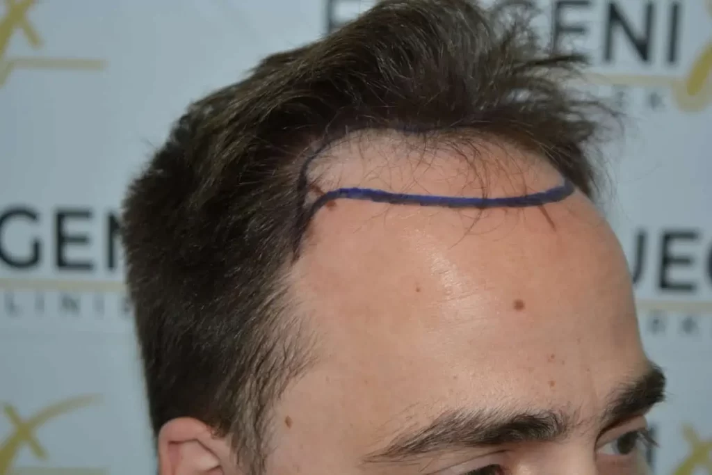 The Hairline That You Dream Of