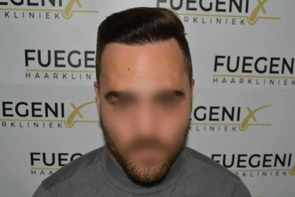 The Hairline That You Dream Of