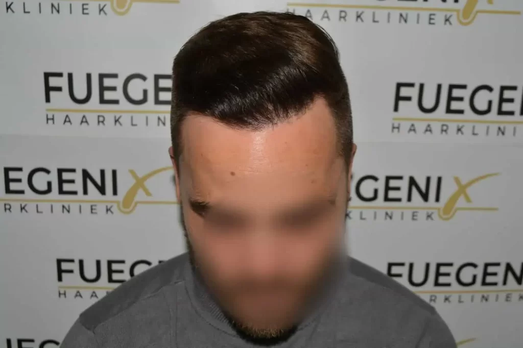 The Hairline That You Dream Of