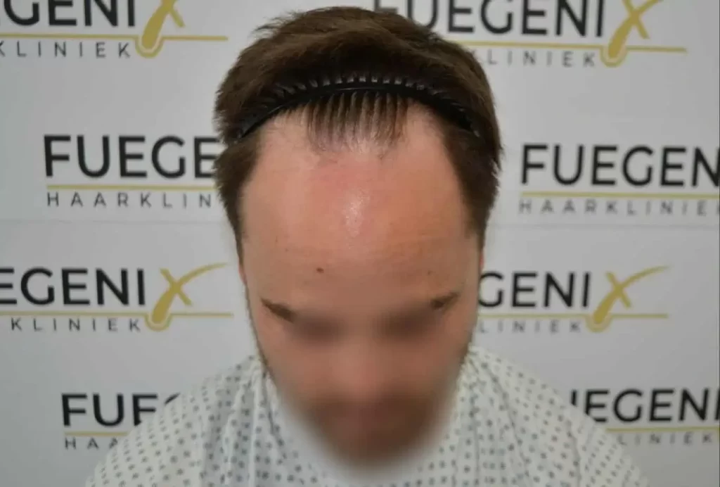 The Hairline That You Dream Of