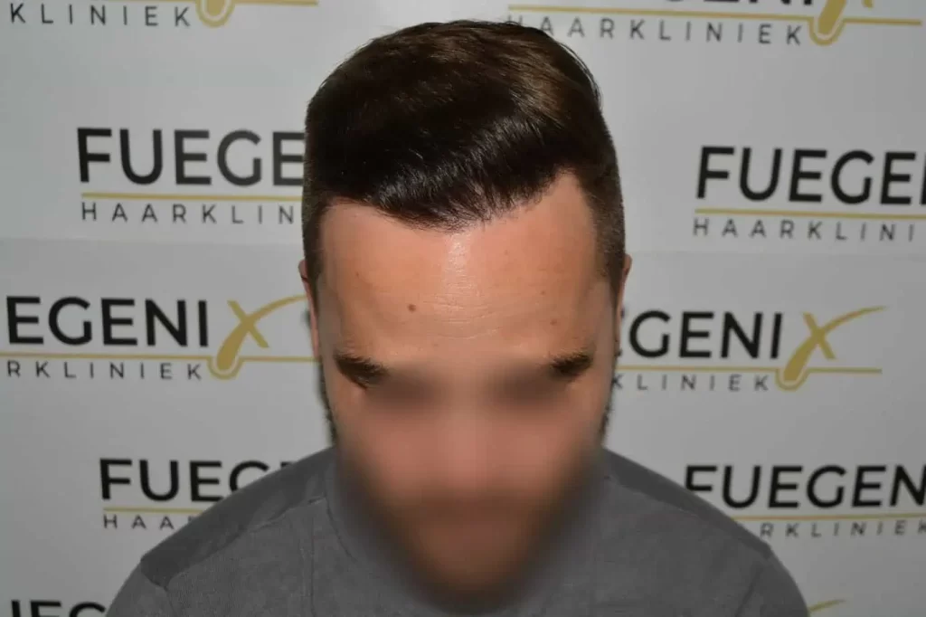 The Hairline That You Dream Of