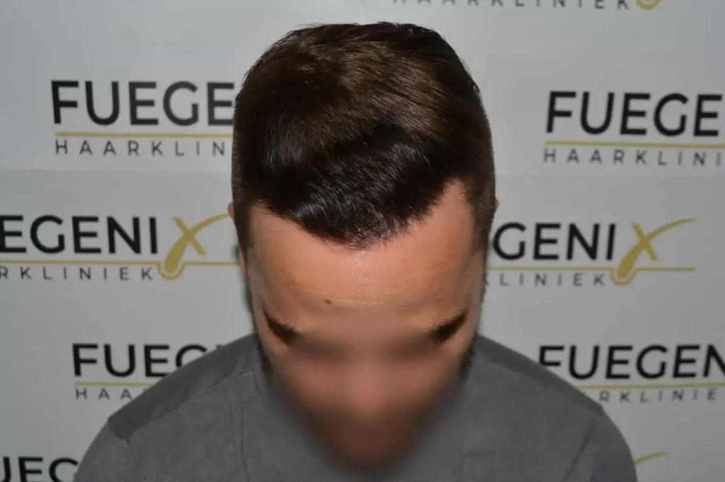 The Hairline That You Dream Of