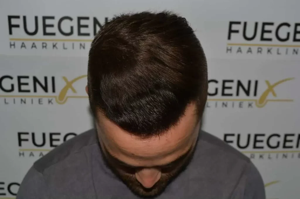 The Hairline That You Dream Of