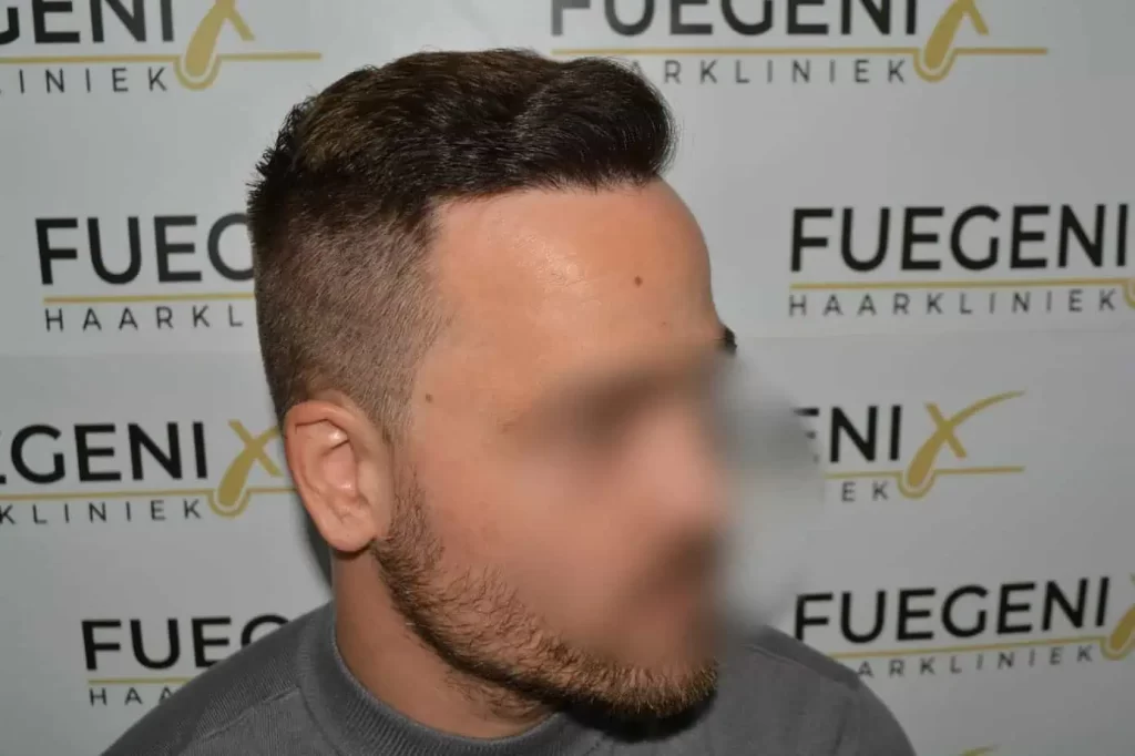 The Hairline That You Dream Of