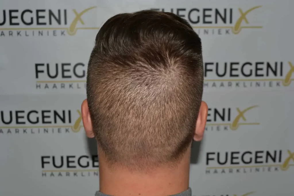 The Hairline That You Dream Of