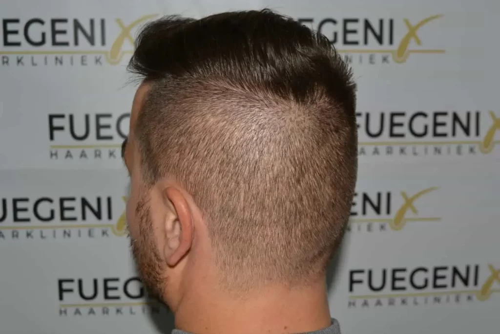 The Hairline That You Dream Of