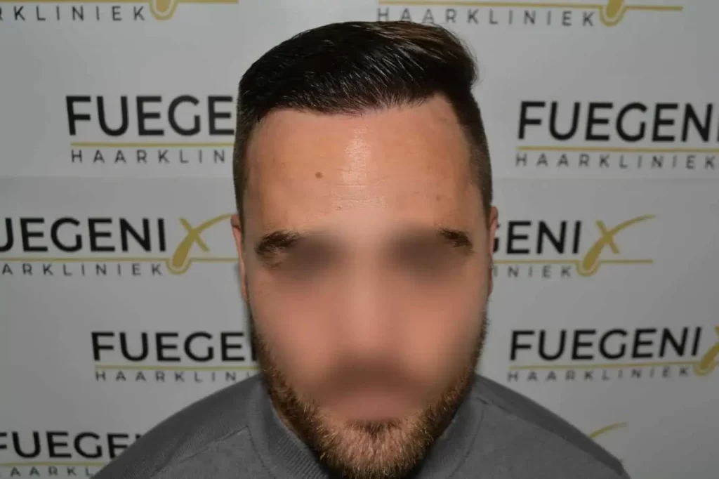 The Hairline That You Dream Of