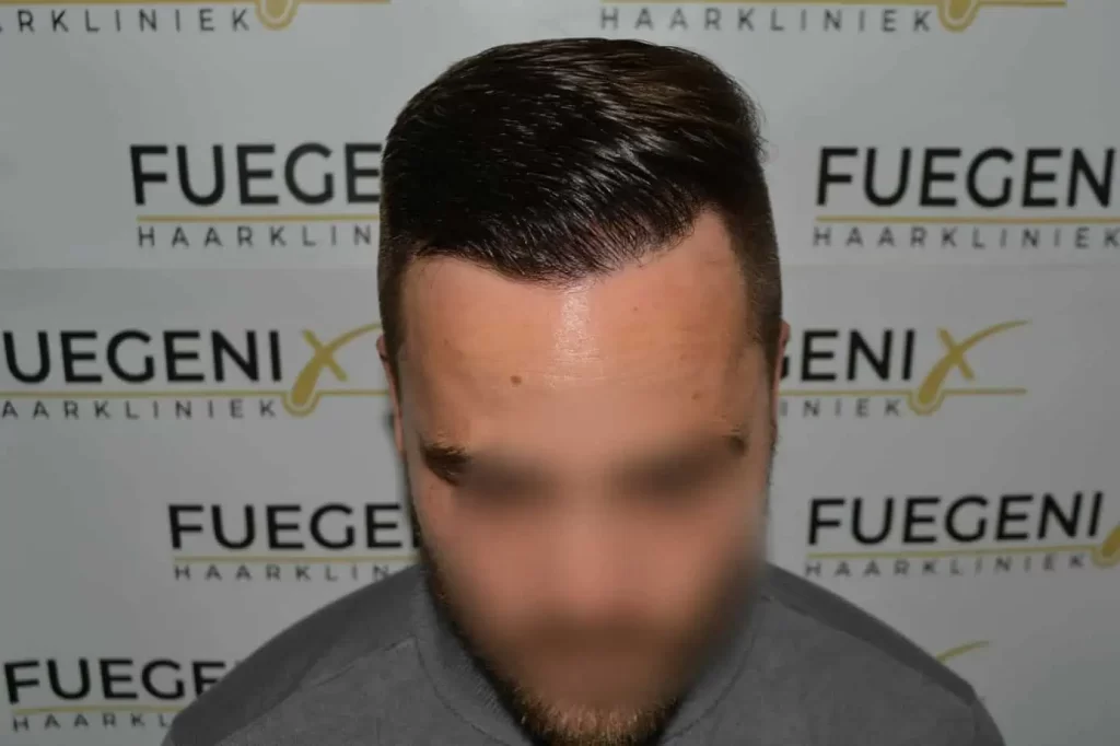 The Hairline That You Dream Of