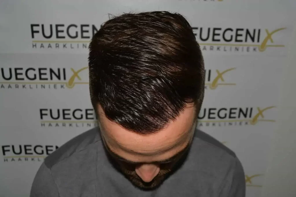The Hairline That You Dream Of