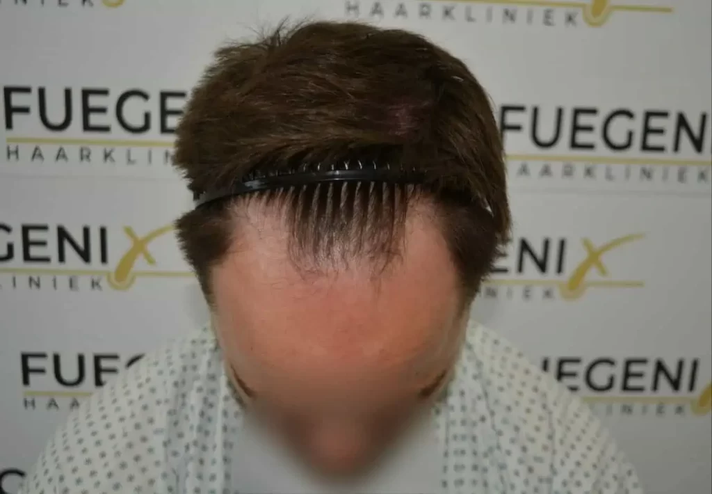 The Hairline That You Dream Of
