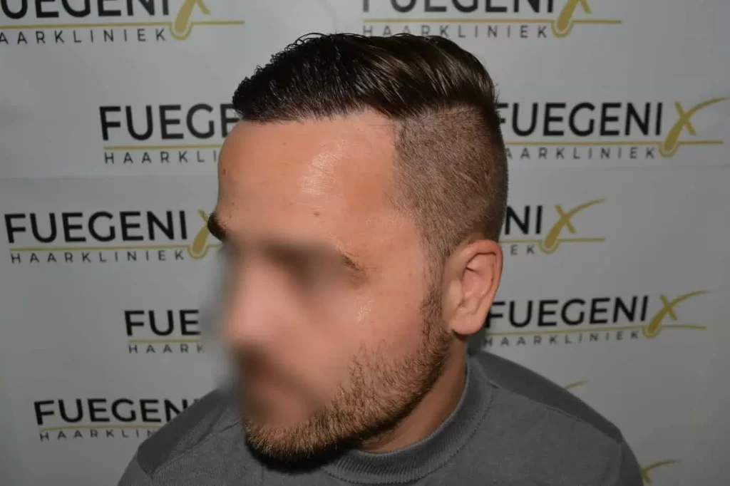 The Hairline That You Dream Of