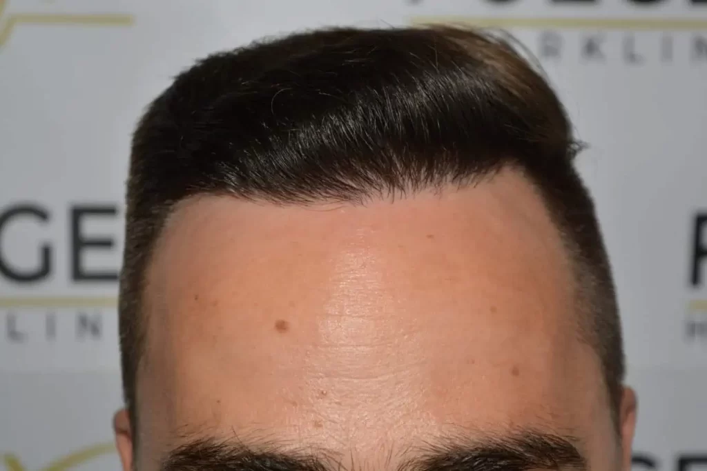 The Hairline That You Dream Of