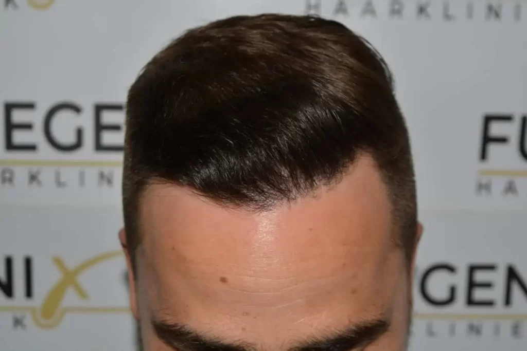 The Hairline That You Dream Of
