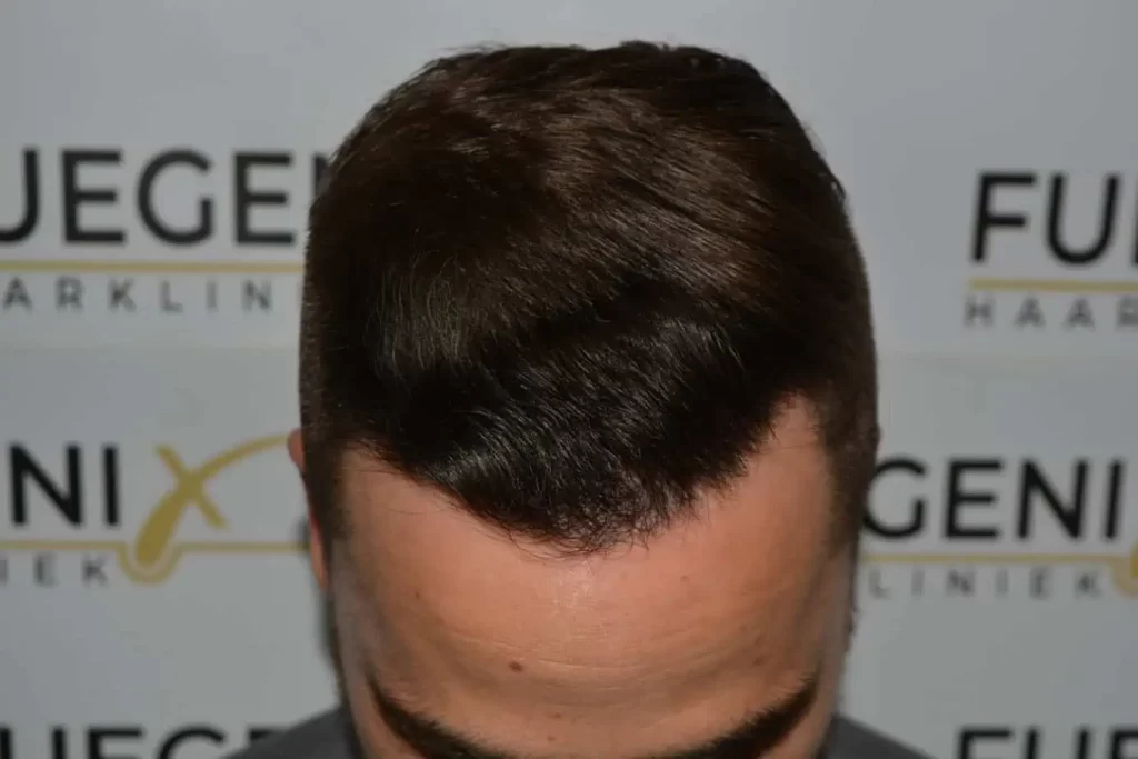 The Hairline That You Dream Of