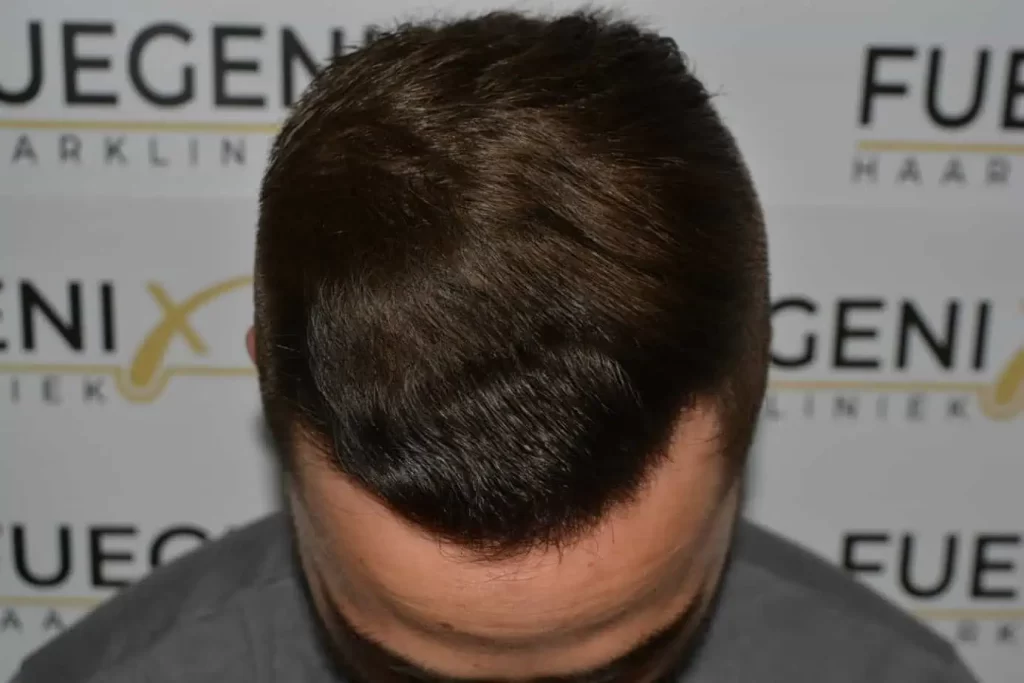 The Hairline That You Dream Of