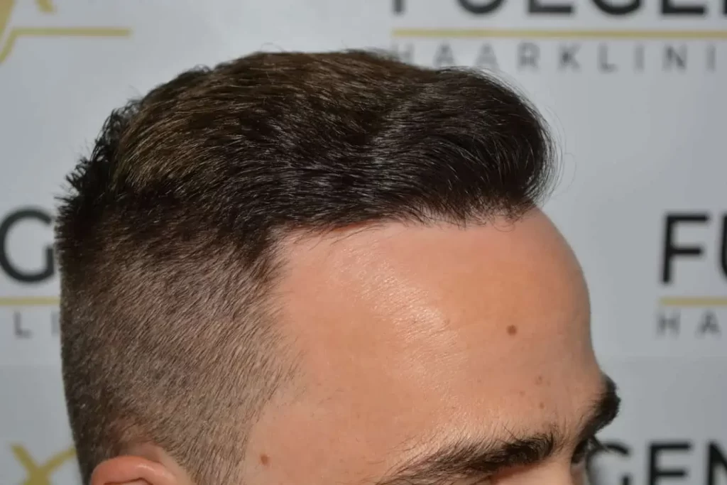 The Hairline That You Dream Of