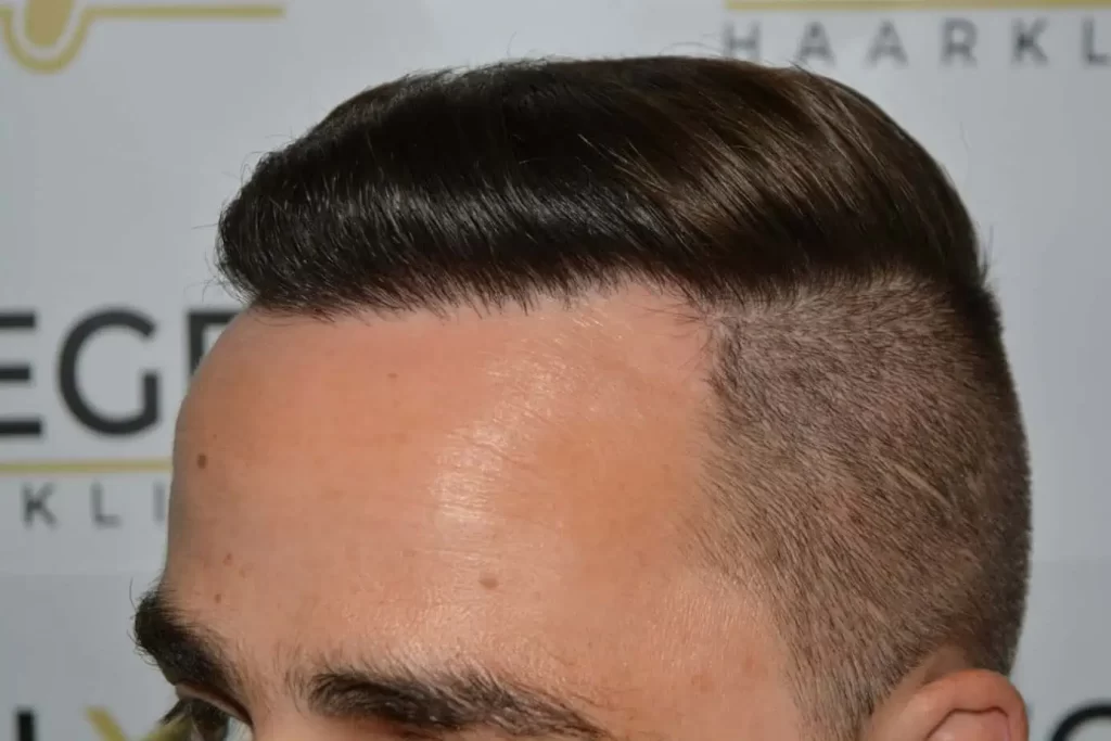 The Hairline That You Dream Of