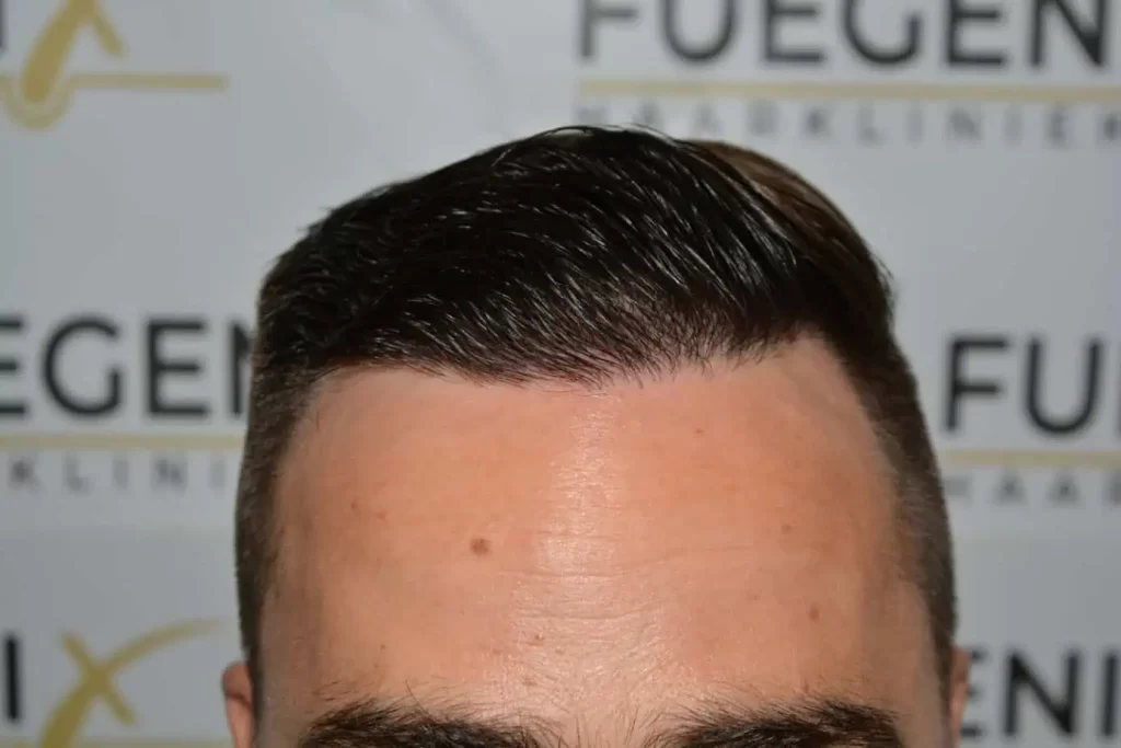 The Hairline That You Dream Of