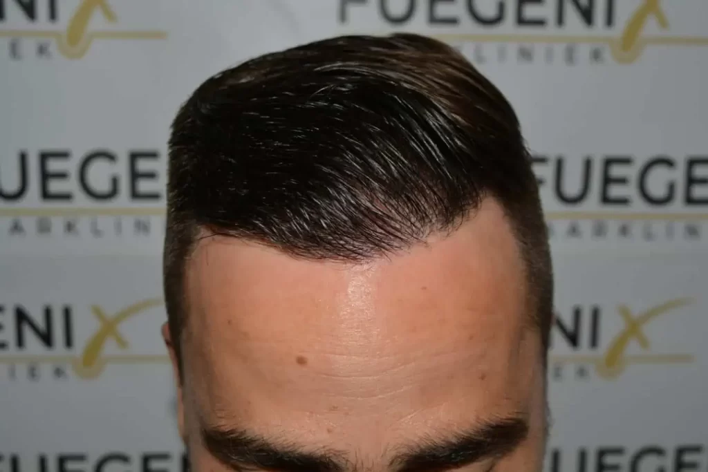 The Hairline That You Dream Of