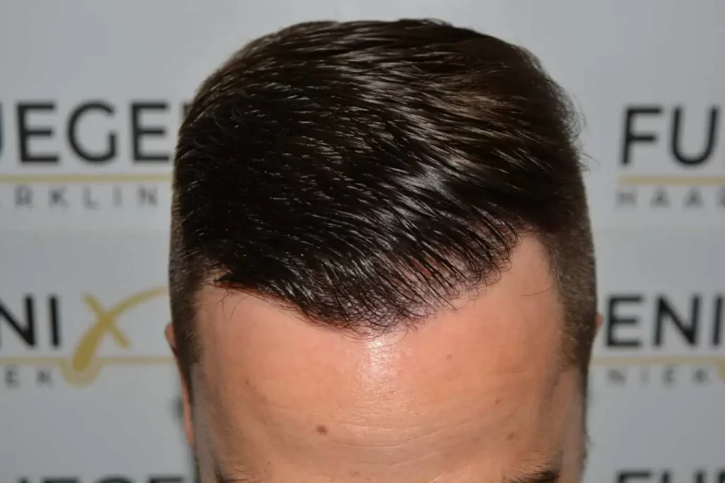 The Hairline That You Dream Of