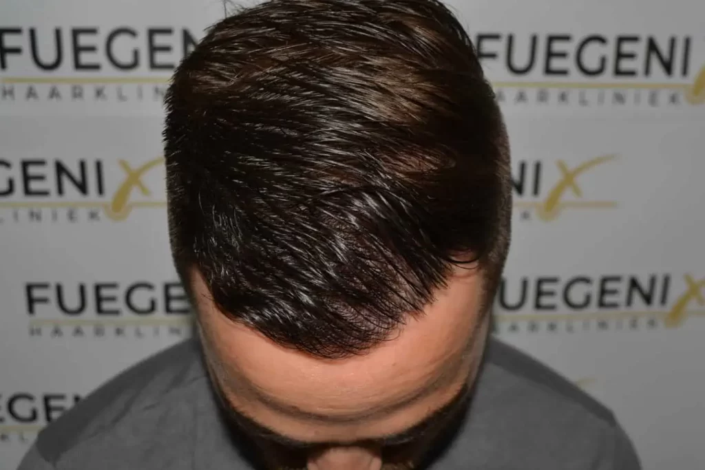 The Hairline That You Dream Of