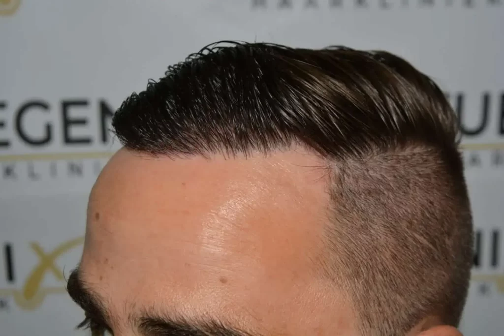 The Hairline That You Dream Of