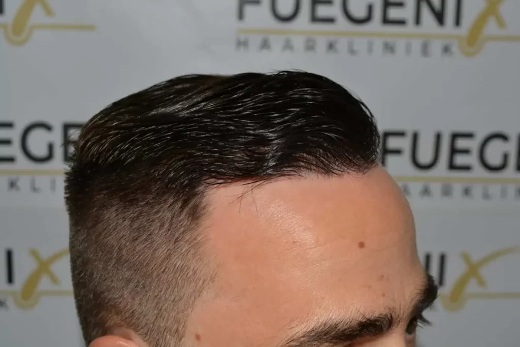 The Hairline That You Dream Of