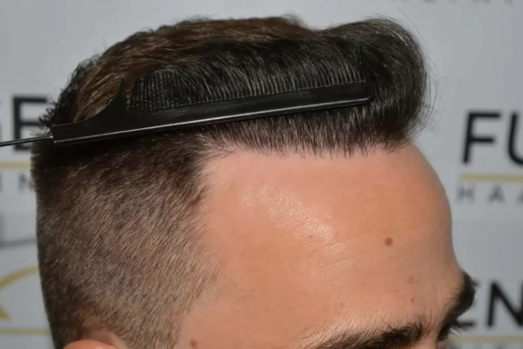 The Hairline That You Dream Of