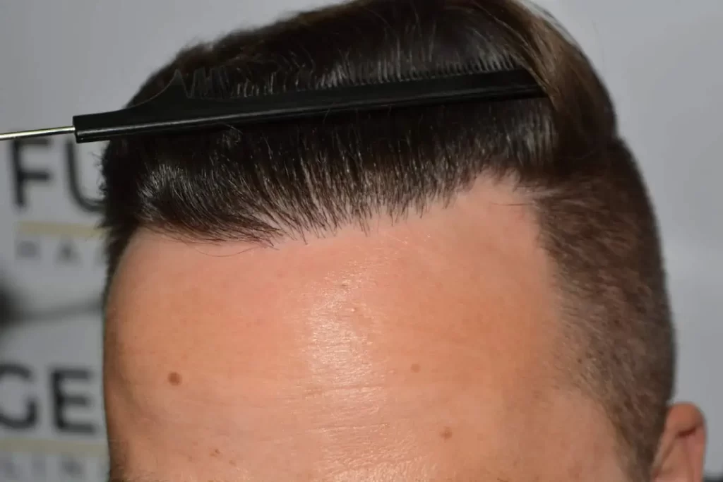 The Hairline That You Dream Of