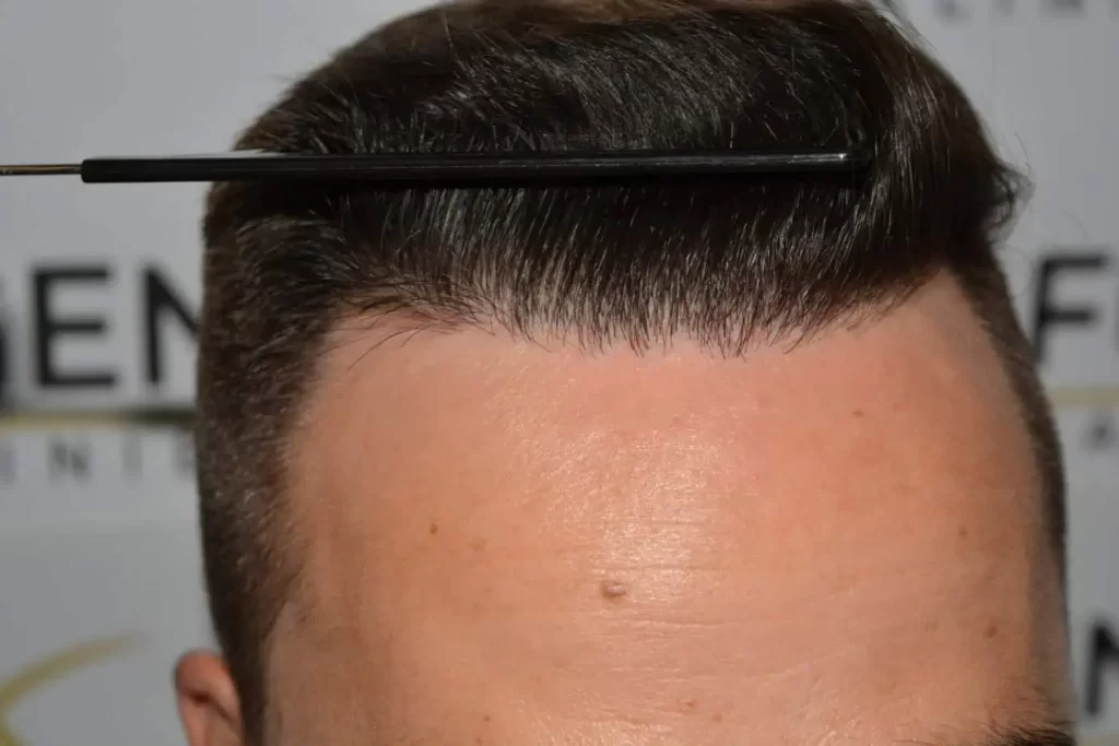 The Hairline That You Dream Of