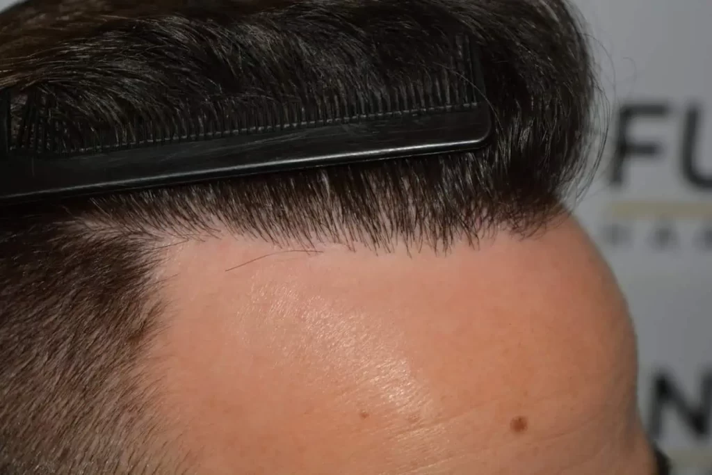 The Hairline That You Dream Of